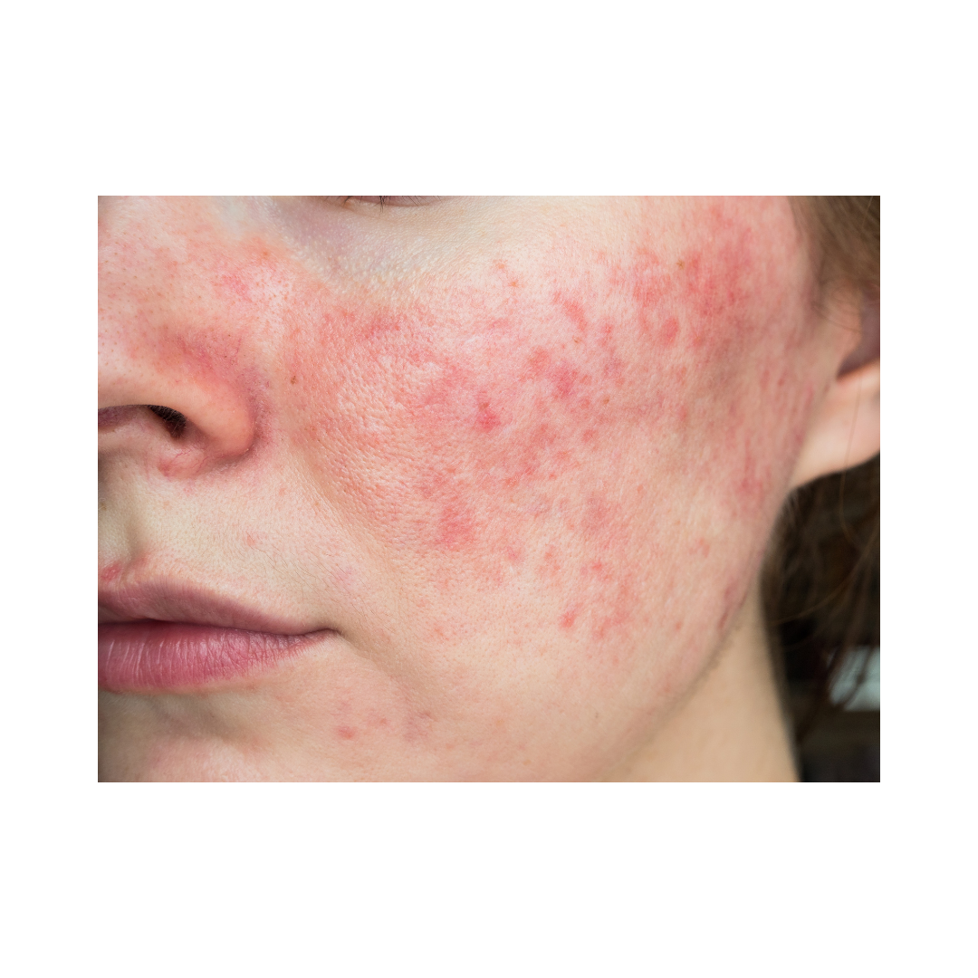 Acne Rosacea  