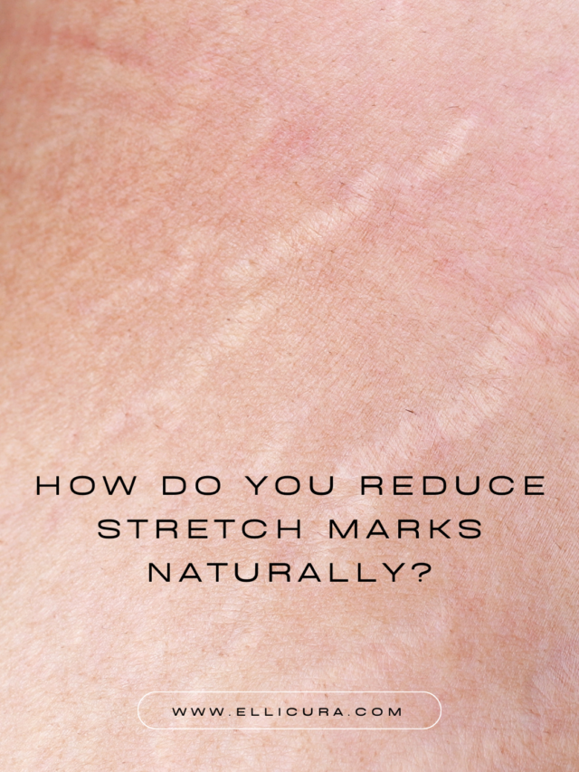 How Do You Reduce Stretch Marks Naturally?